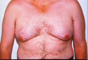 Photo of a man's chest before a gynaecomastia procedure