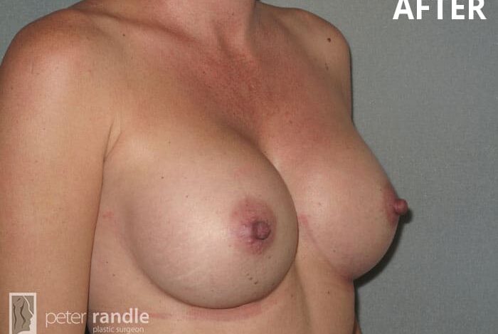 Breast-Augmentation-Eight-After