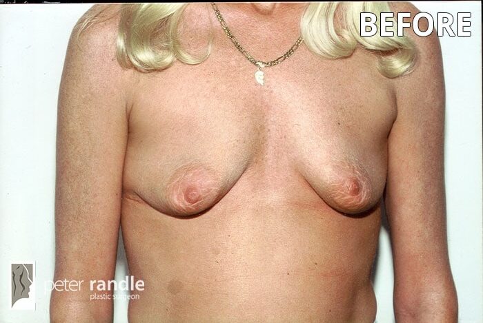 Breast-Augmentation-Four-Before