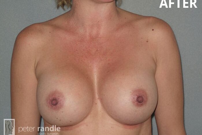Breast-Augmentation-Seven-After