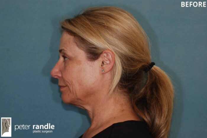 Face Lift 4