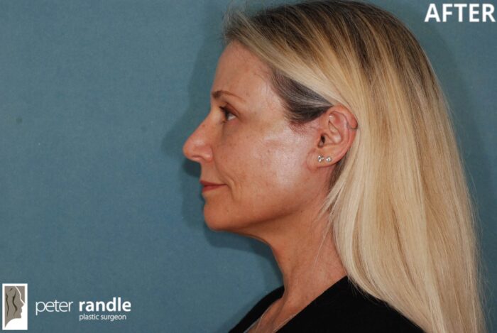 Face Lift 4.4