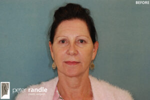 Facelift Before 2 Facelift & Neck Lift 3
