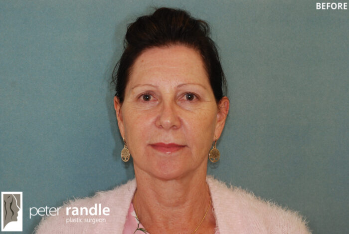 Facelift Before