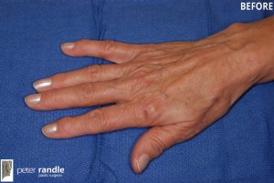 A photo of a woman's hands before getting a fat grafting procedure