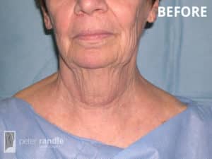 Necklift Before 1 Facelift & Neck Lift 7