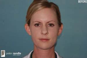 Photo of a woman before an otoplasty procedure