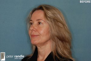 Photo of a woman before a rhinoplasty procedure