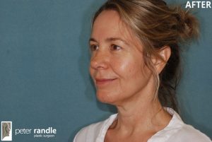 Photo of a woman after a rhinoplasty procedure