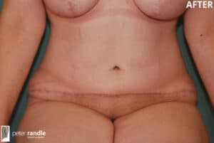 Tummy 2 Abdominoplasty 5