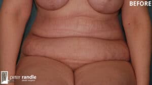 Tummy 3 Abdominoplasty 3