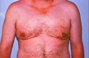 Photo of a man's chest after a gynaecomastia procedure