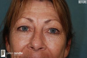 Photo of a woman before a blepharoplasty procedure