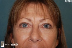 Photo of a woman after a blepharoplasty procedure