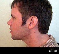 Photo of a man after a mandibuloplasty