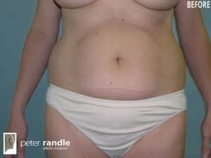 A photo of a woman's torso before a liposuction procedure